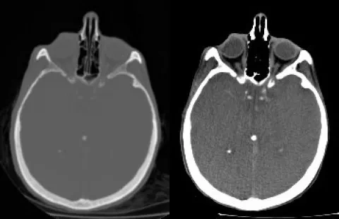 Snímka ľudskej hlavy vytvorená počítačovým tomografom