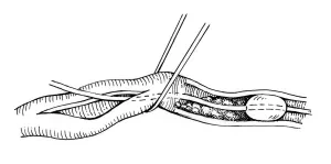 Odstránenie embolu z cievy pomocou balónikového (Fogartyho) katétra
